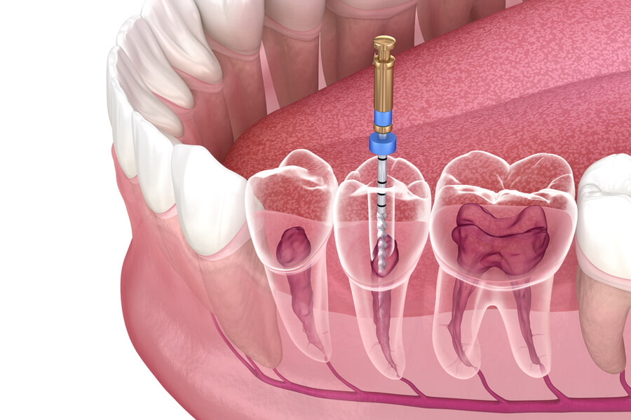 Endodonzia